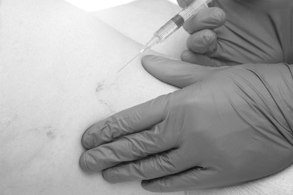 terapia sclerosante medicina estetica parmeggiano