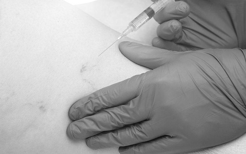 terapia sclerosante medicina estetica parmeggiano